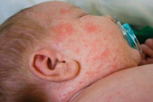 Cazurile de rujeolă s-au răspândit în aproape toată Prahova. 20% dintre bolnavi erau VACCINATI!