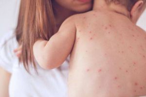 Bacăul, în top-ul judeţelor cu noi cazuri de rujeolă