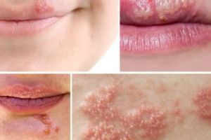 Tratament naturist pentru herpes