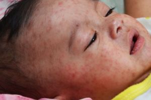 Stocuri suficiente de vaccin, număr mare de refuzuri