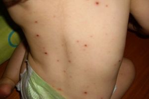 15 cazuri de RUJEOLA in Prahova, in ultima saptamana. 9 dintre ele s-au inregistrat la copii sub 4 ani