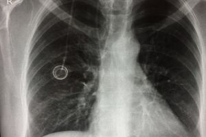 Metode moderne pentru tratamentul bolnavilor de cancer, la Spitalul Judetean Constanta