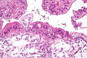 CANCERUL a suferit O MUTAȚIE PERICULOASĂ. Oamenii de ştiinţă AVERTIZEAZĂ! Femeile, mai EXPUSE ca NICIOADATĂ