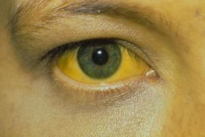 Zeci de persoane, majoritatea copii, cu hepatita A la Gheorgheni