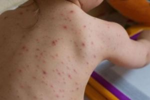 Prahova, fruntasa la imbolnaviri! 23 de cazuri noi de RUJEOLA in ultima saptamana