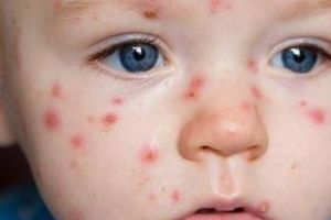 Apar tot mai multe cazuri de rujeolă şi în judeţul Bacău