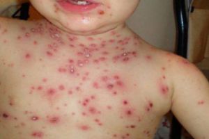 43 de noi cazuri de RUJEOLA in Prahova, in ultima saptamana