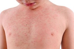 5 cazuri noi de RUJEOLA in Prahova, in ultima saptamana