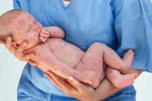 Judeţul Bacău: S-a înregistrat al treilea deces din cauza rujeolei