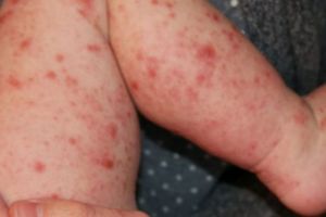 Un copil de 11 luni din Prahova, nevaccinat, a murit din cauza rujeolei