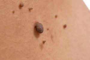 Legătura dintre ALUNIȚE şi CANCER. Experţii au EXPLICAT DE CE şi CÂND trebuie sa ne ÎNGRIJORĂM