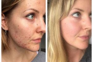 Acneea şi-a găsit leacul. O femeie din Anglia a găsit remediul. ESTE ATÂT DE SIMPLU… Cine s-ar fi aşteptat?