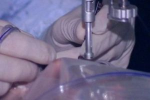 REVOLUŢIE în MEDICINĂ. Tehnica UNICĂ a impresionat medicii din întreaga lume. Primii pacienţi s-au VINDECAT COMPLET