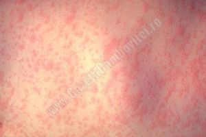 O GRAVIDĂ INFORMATĂ: Rubeola în sarcină, boală fără tratament