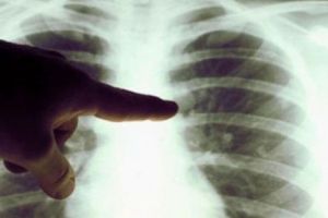 VIDEO – Cazurile de tuberculoză la Sibiu. Stăm bine în statistici