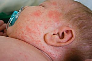 Al patrulea copil mort de rujeolă