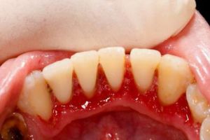 Tratamente naturiste pentru gingii inflamate 