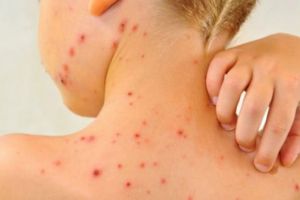 Un singur caz de RUJEOLA in judetul Prahova, in ultima saptamana