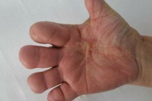 Un medic ACUZĂ sistemul! Femeia care a suferit un ACCIDENT CUMPLIT de muncă a fost declarată APTĂ şi fără GRAD DE INVALIDITATE