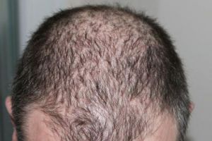 Cum tratezi caderea excesiva a parului cu CEAPA 