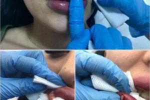 La o clujeancă i-au explodat buzele, după un tratament de mărire - FOTO