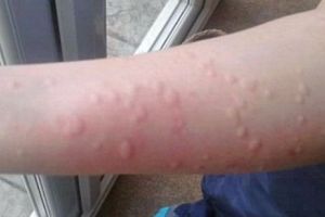 De ce fac COPIII ALERGII. Un studiu recent a scos la LUMINĂ întreg ADEVĂRUL