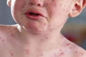 Campioni la rujeolă: Aproape 500 de cazuri de rujeolă au fost confirmate, de la începutul anului