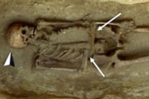 Schelet cu o lamă de cuţit în loc de mână, găsit în Italia