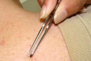 Începe sezonul muşcăturilor de căpuşă!