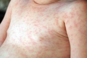 Un singur caz de RUJEOLA in judetul Prahova, in ultima saptamana