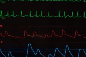 Fibrilaţie, dar să ştim şi noi ce înseamnă.