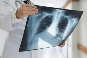 Pneumonia a mai curmat o viaţă. Zeci de internaţi în spital cu boli respiratorii