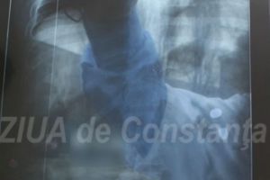 24 Martie 2026 – Ziua Mondiala de Lupta Impotriva Tuberculozei: O provocare de sanatate publica la 144 de ani de la descoperirea bacilului Koch