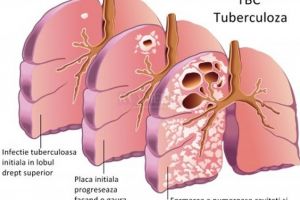 România continuă să înregistreze cea mai ridicată rată a incidenţei Tuberculozei din Uniunea Europeană