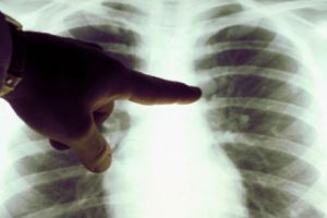 Mii de radiografii la Dispensarul TBC de la Târgu Jiu