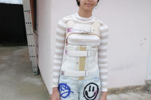 Erika luptă la 15 ani cu o scolioză severă: ”Fiecare zi îmi curbează coloana tot mai mult… Operaţia este şansa mea.”