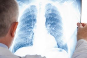 VIDEO Caz de TBC la un liceu din judeţul Botoşani. „Au fost recoltate analize şi de la ceilalţi elevi”