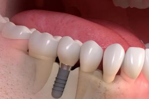 Cât rezistă un implant dentar şi cum îi poţi prelungi durata de viaţă
