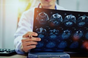 Consultaţii gratuite de neurologie la Spitalul Judeţean