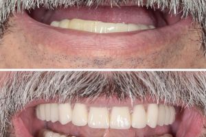 Proteza fixă pe implanturi la Dental Premier Bucureşti – ce presupune şi când este indicată?