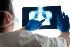 Doi oameni au murit din cauza pneumoniei şi 70 s-au internat în spital