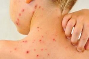 Rujeola tratată cu leacuri băbeşti