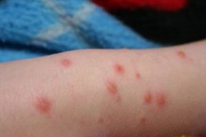 RUJEOLA loveşte din nou! Avem 55 de DECESE, iar ULTIMA VICTIMĂ e un bebeluş de 3 luni din Iaşi