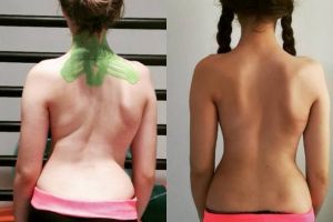 Miracol pentru fetita din Ploiesti care merge la scoala in pat pliant! Coloana ei a inceput sa se indrepte