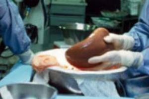 Transplantat de ficat de la o femeie de 97 de ani la una de 64 de ani. Tehnica „bătrân pentru bătrân” 