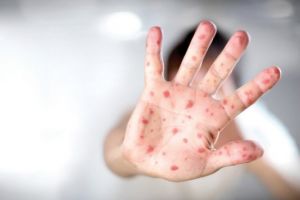 Suntem tari la ce nu trebuie… Vasluiul, vicecampion naţional la pojar!