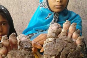 Drama copiilor cu picioare de piatră. Incredibil ce se întâmplă cu pielea lor. Nu pot fi SALVAȚI!