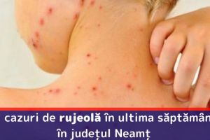 Institutul Naţional de Sănătate Publică: 41 cazuri de rujeolă în ultima săptămână în judeţul Neamţ