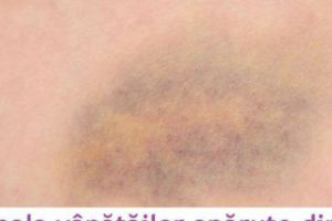 Boala vânătăilor apărute din senin.   Atacă din ce în ce mai multe femei!  