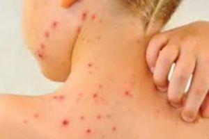 Peste 200 de cazuri de rujeolă în ultima săptămână. 16 judeţe sunt afectate, printre care şi Clujul